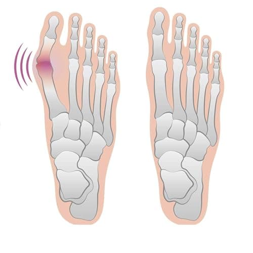 VBQFDPH 4 Bunion Relief Pads and Sleeves, Orthopedic Bunion Corrector Socks with Gel Pads, 2 Pairs