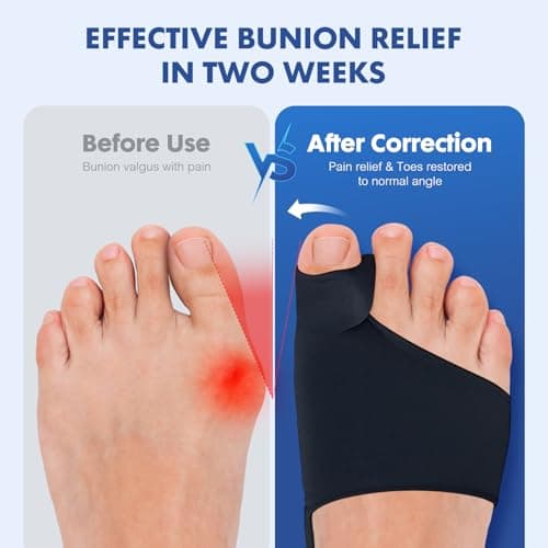 2PCS Bunion Corrector for Women & Men - Toe Alignment Corrector with Splint & Pads for Hallux Valgus Pain Relief, Toe Separator for Day/Night Support, New Anti Slip Gel Strap for Big Toe Straightener